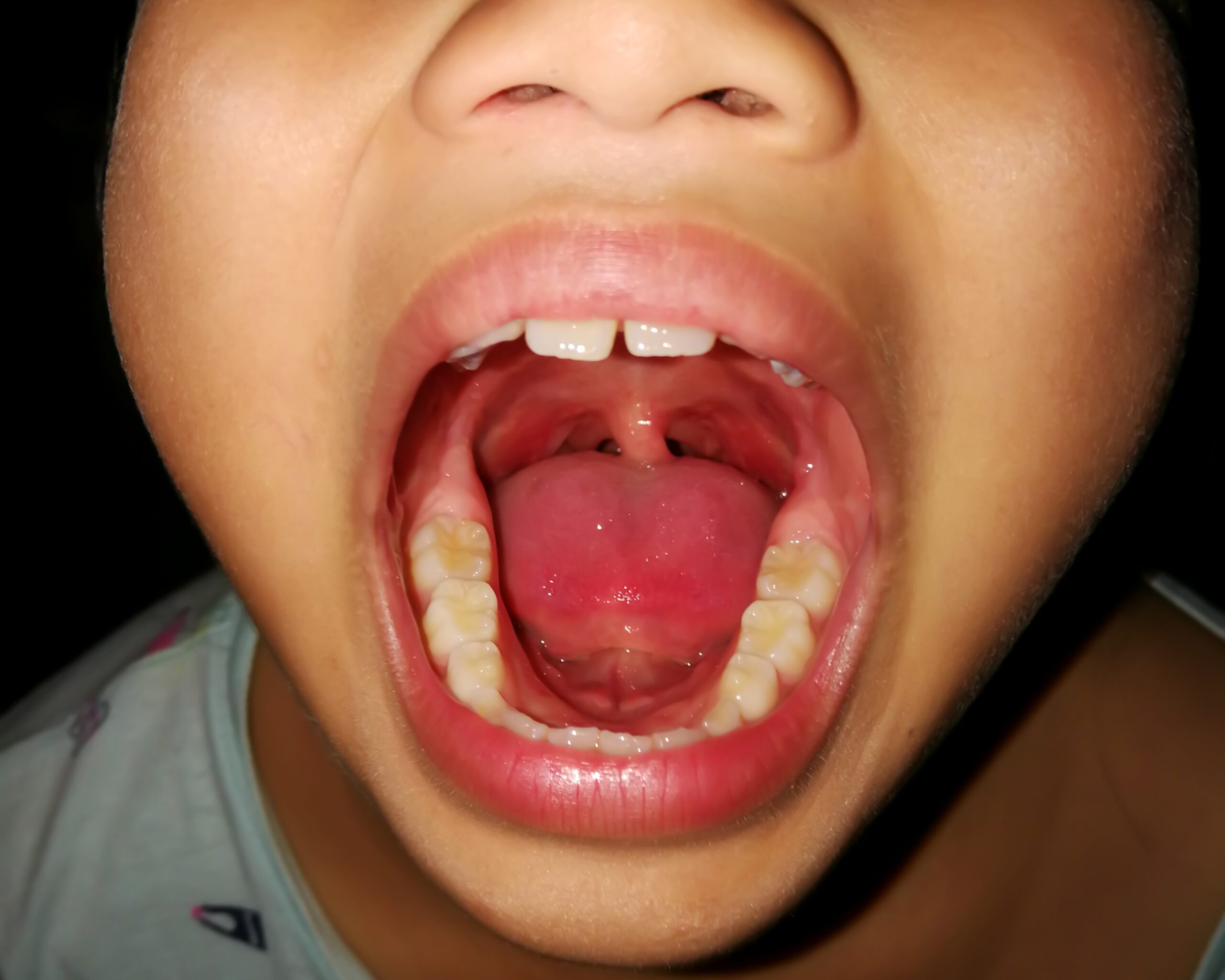 Close-up of a child's mouth with lips open wide, showing upper and lower teeth and gums from below.
